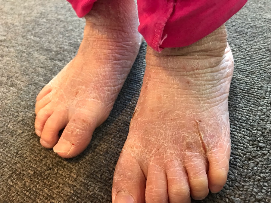 足の痒み7回めの治療
